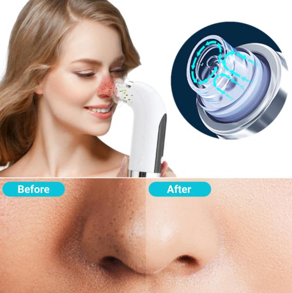 Blackhead Vacuum Facial - Skincare - HealthValley